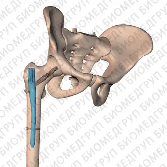 Интрамедуллярный штифт бедренная кость TFP