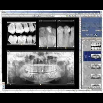 Программное обеспечение для обработки снимков зубов PROGENY