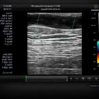 UltraSonix SonixSP Аппарат УЗИ