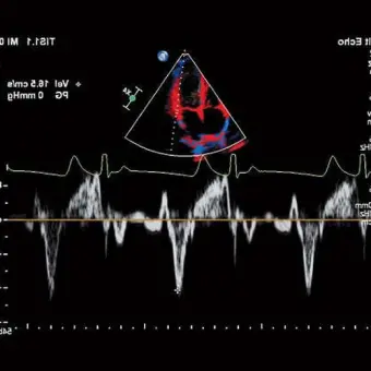 Philips Affiniti 30 Аппарат УЗИ