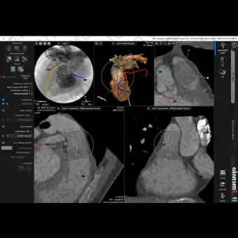 Анатомическое программное обеспечение 3mensio Pulmonary valve