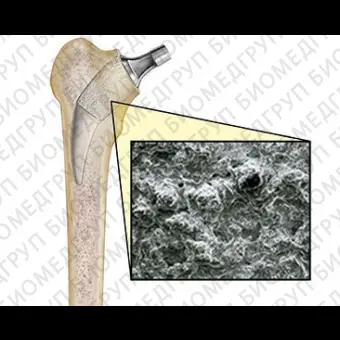 Протез бедренной кости без цемента Alteon