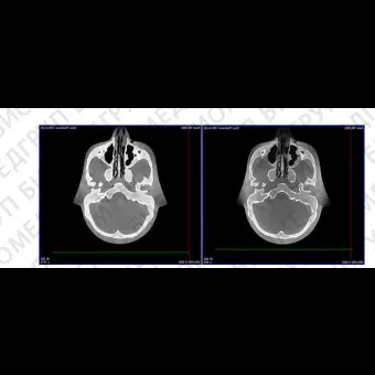 Программное обеспечение для медицинских снимков CBCT