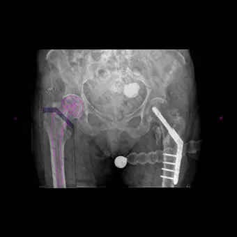 Программное обеспечение для хирургии тазобедренного сустава Hip Arthroplasty