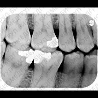 Внутриротовой сканер фосфорных пластин ScanX Duo