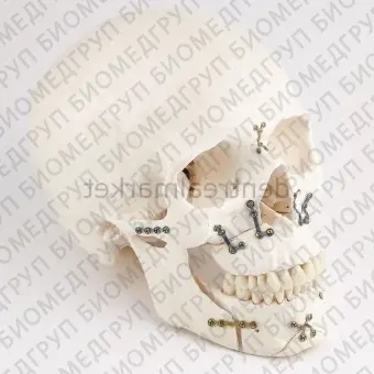 Компрессионная костная пластина для челюстнолицевого восстановления 56.10.116A